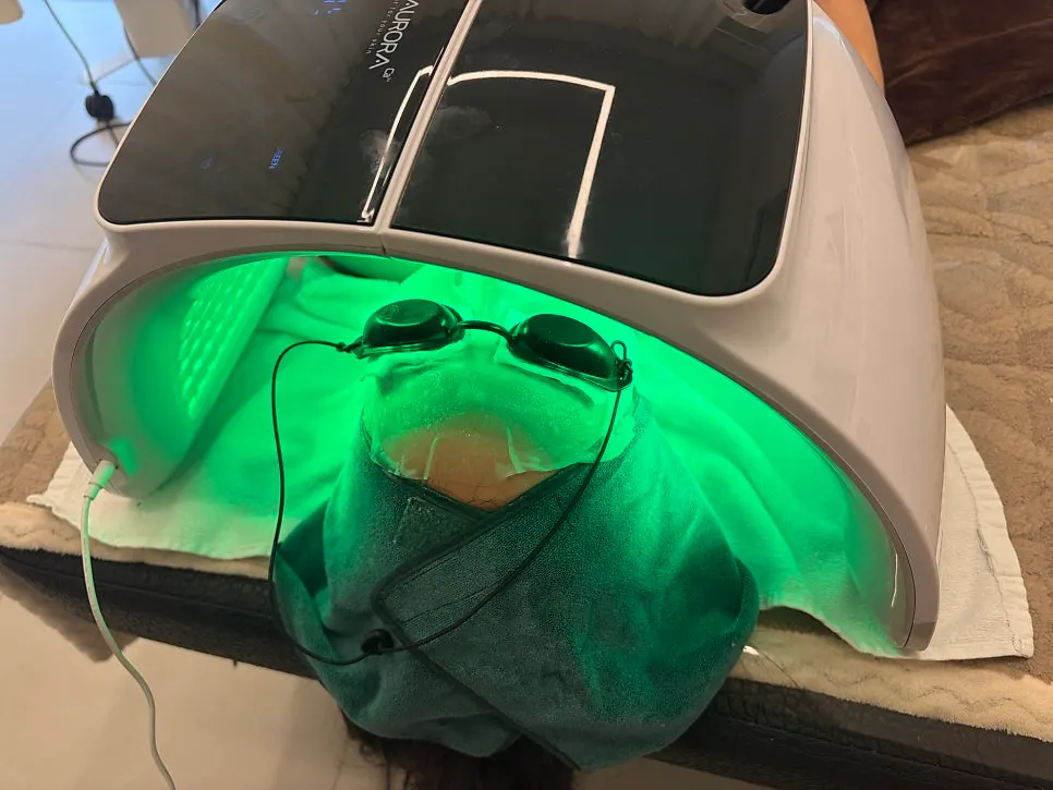 RF treatment performed along the facial lines