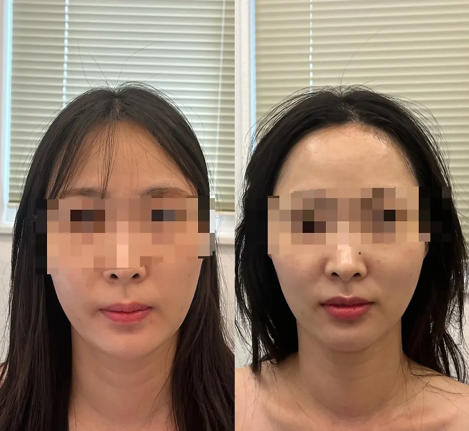 Treatment finishing with a mask and dedicated device