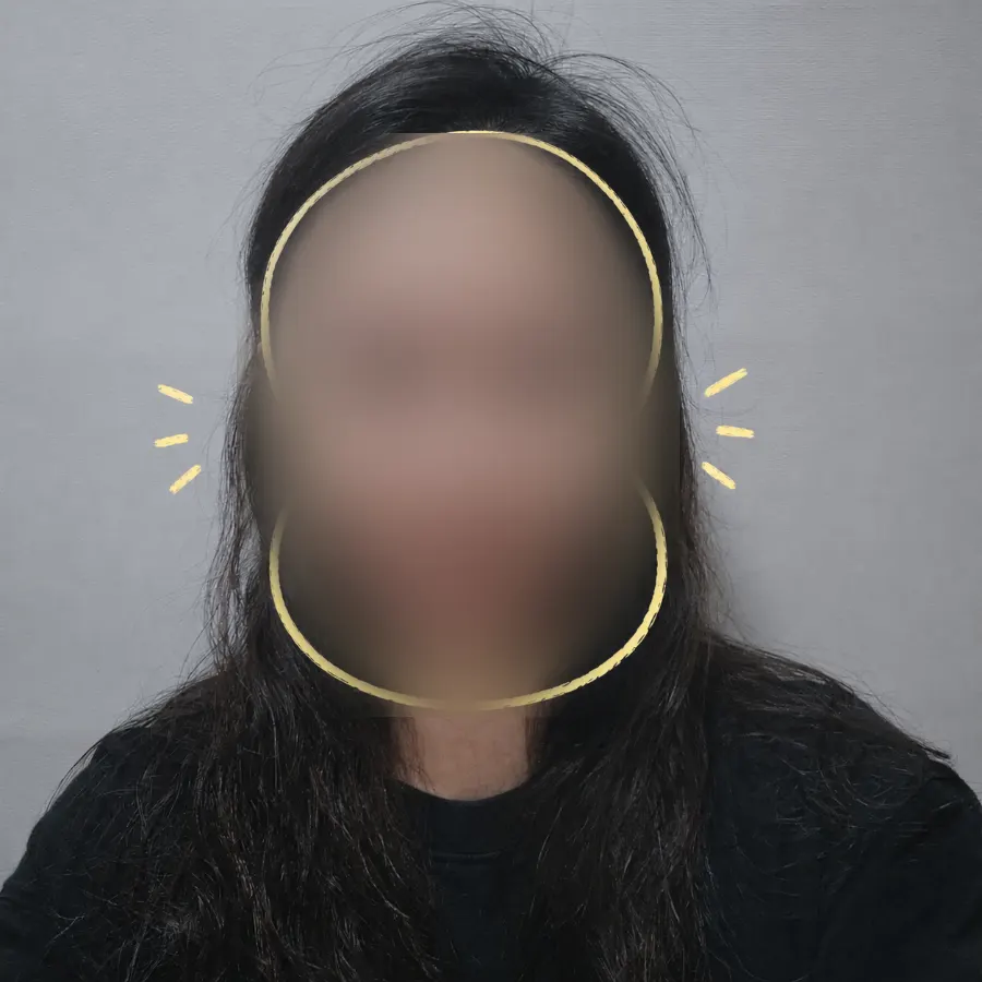 Pre-treatment selfie showing faceline concerns