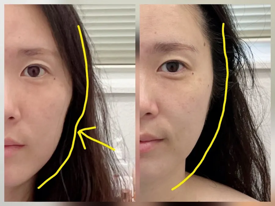 Before and after comparison photo of the faceline