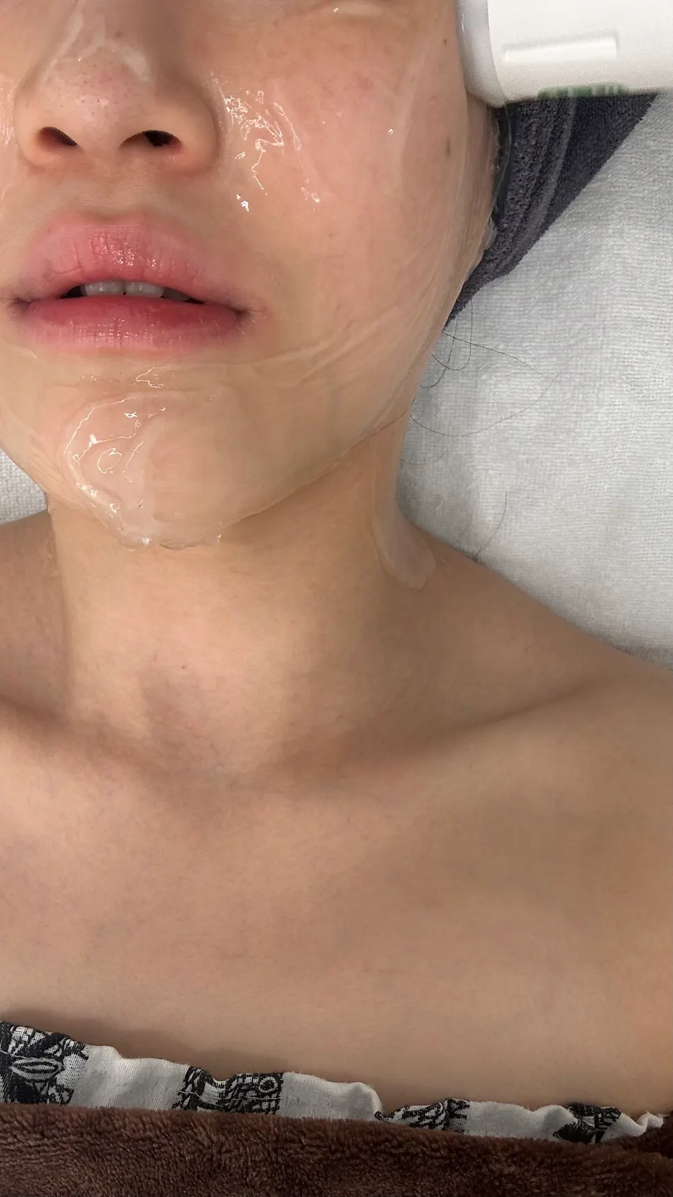 Receiving the HIFU lifting treatment