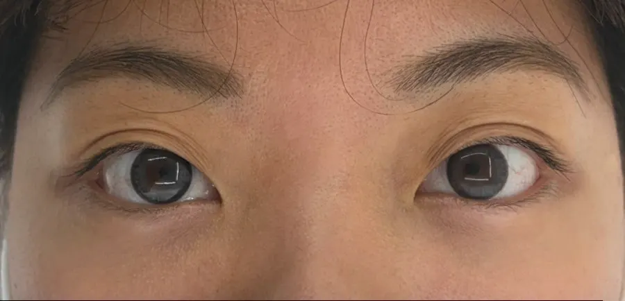 Inner-corner lash curl treatment result