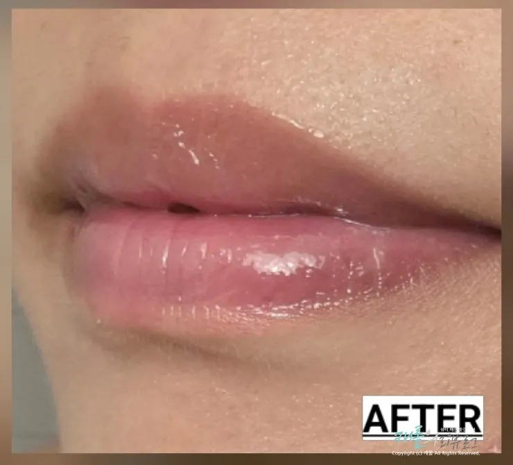 Using the lip mask for nighttime care