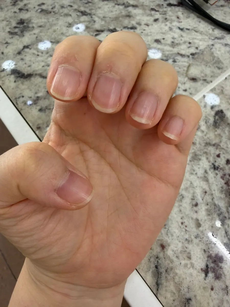 Nails before treatment with grown-out cuticles