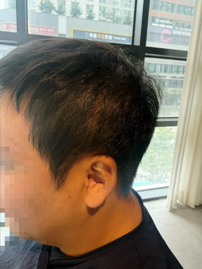 시술 전 남성 뒷머리 기장