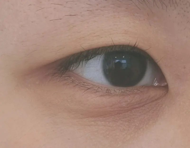 속눈썹펌 시술 전 처진 속눈썹 눈매