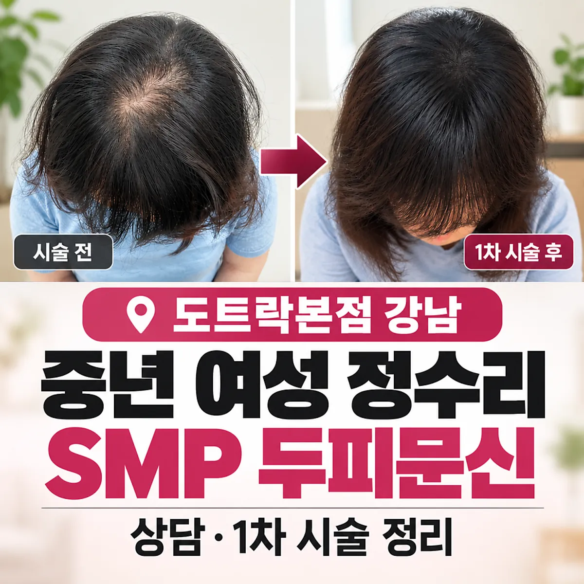 중년 여성 정수리 SMP 두피문신 안내 대표 이미지