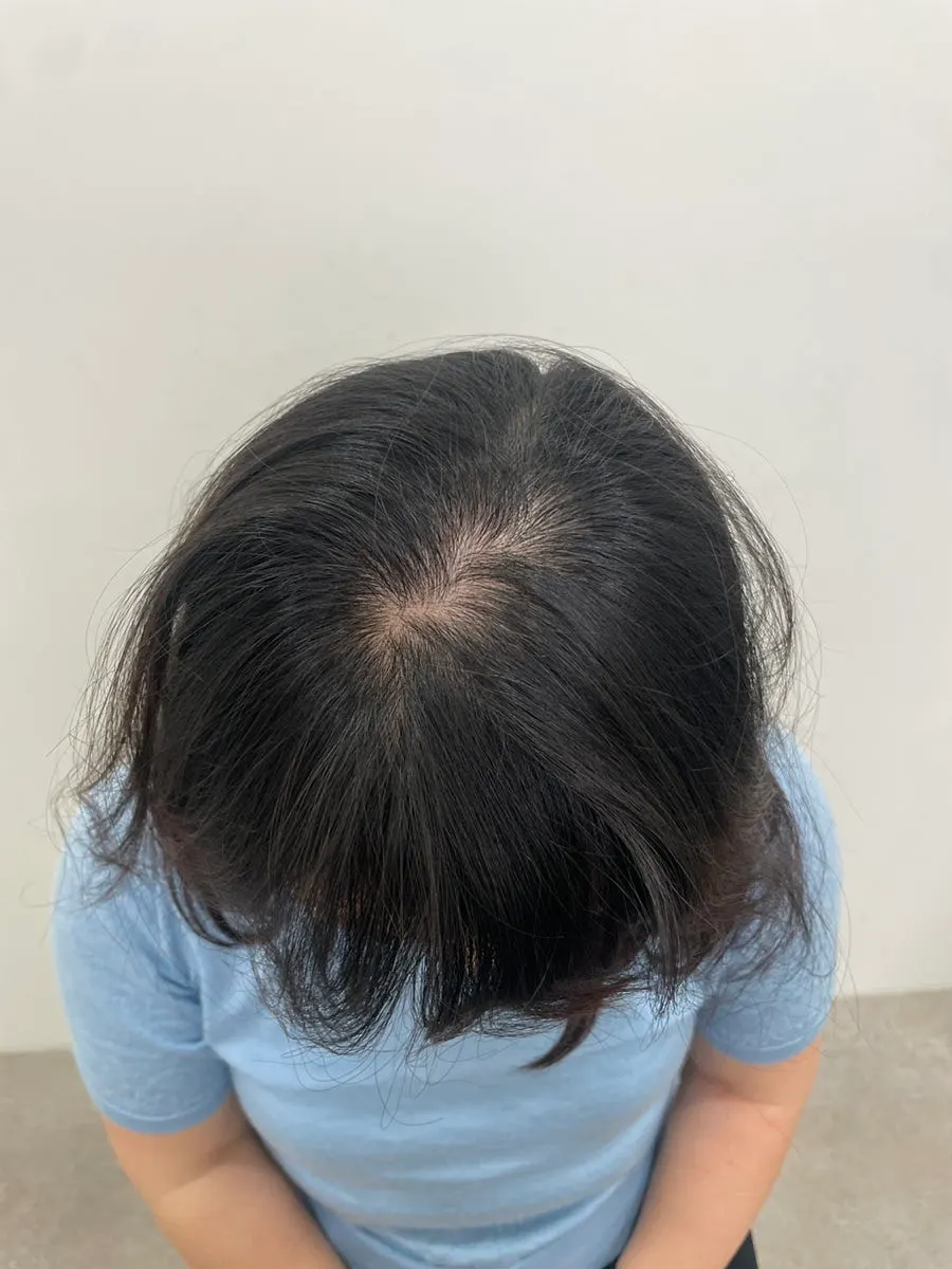 정수리 두피문신 정리 이미지