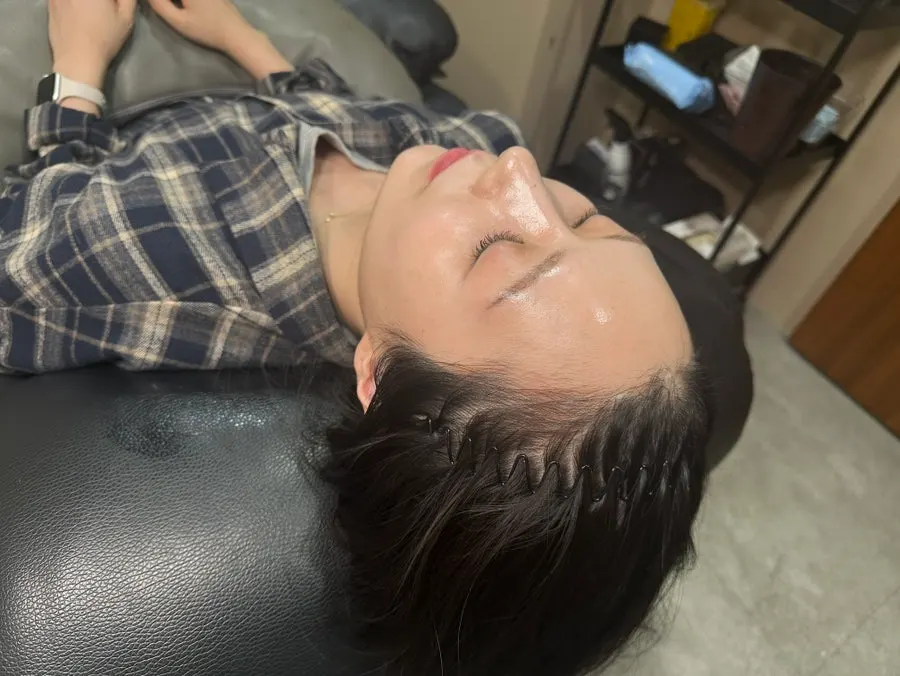 두피가 비쳐 보이는 헤어라인 시술 중 모습