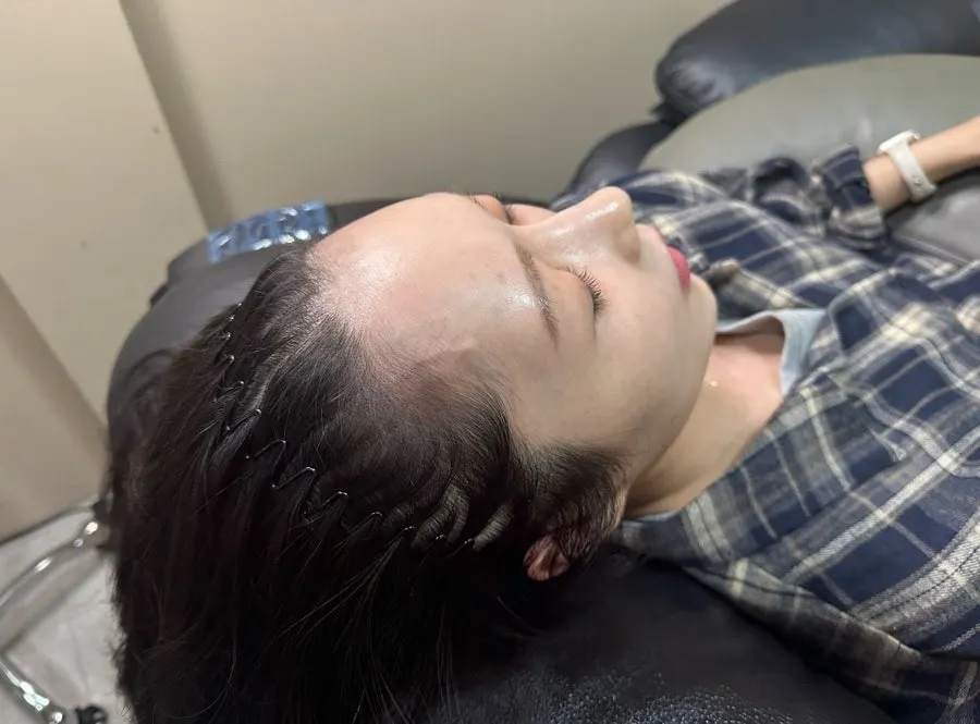 헤어라인 SMP 1회차 시술 직후 이마 라인