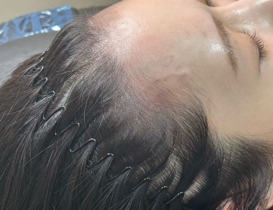 모근이 채워진 헤어라인 확대 사진