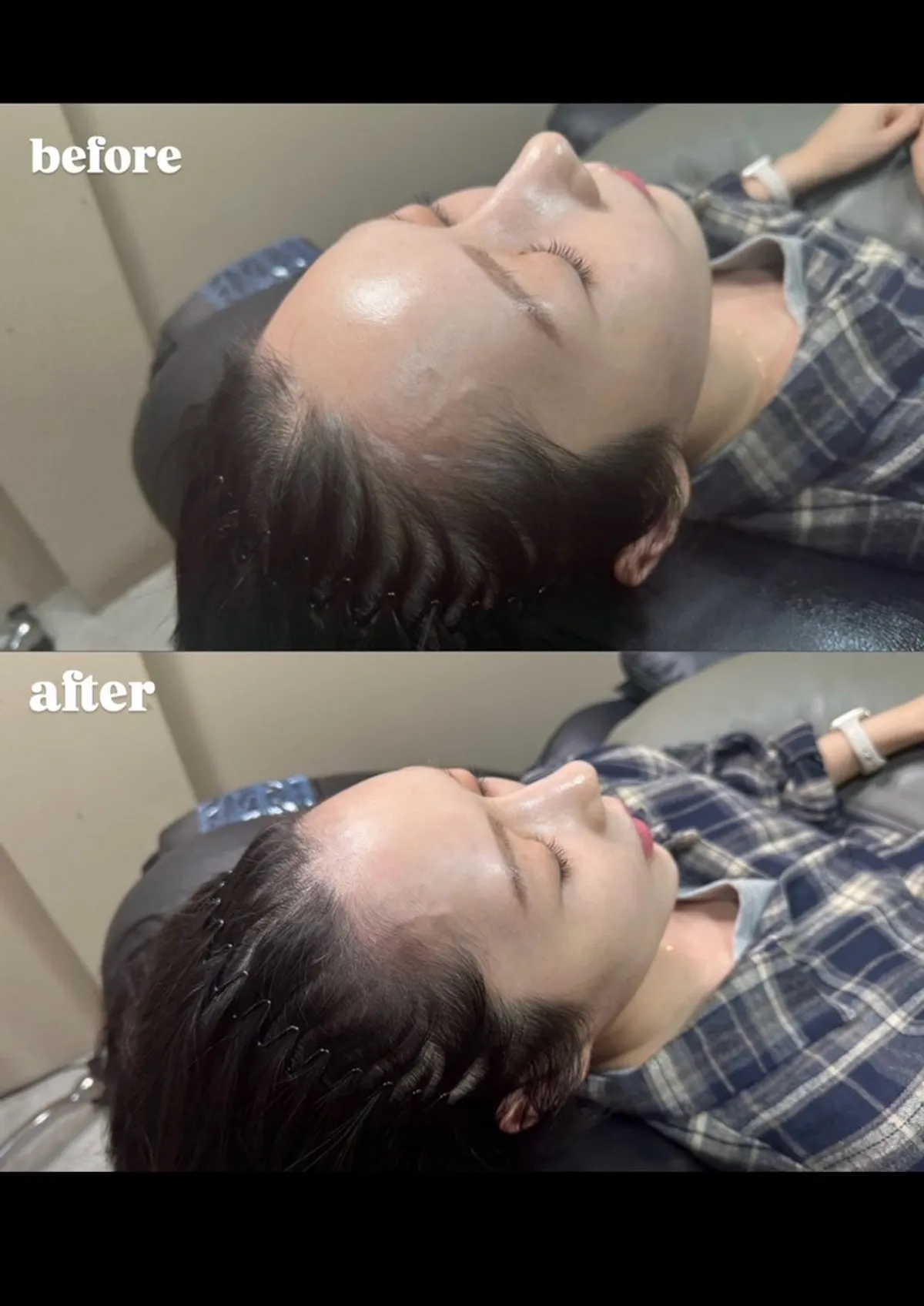 헤어라인 SMP 1회차를 마친 정면 모습