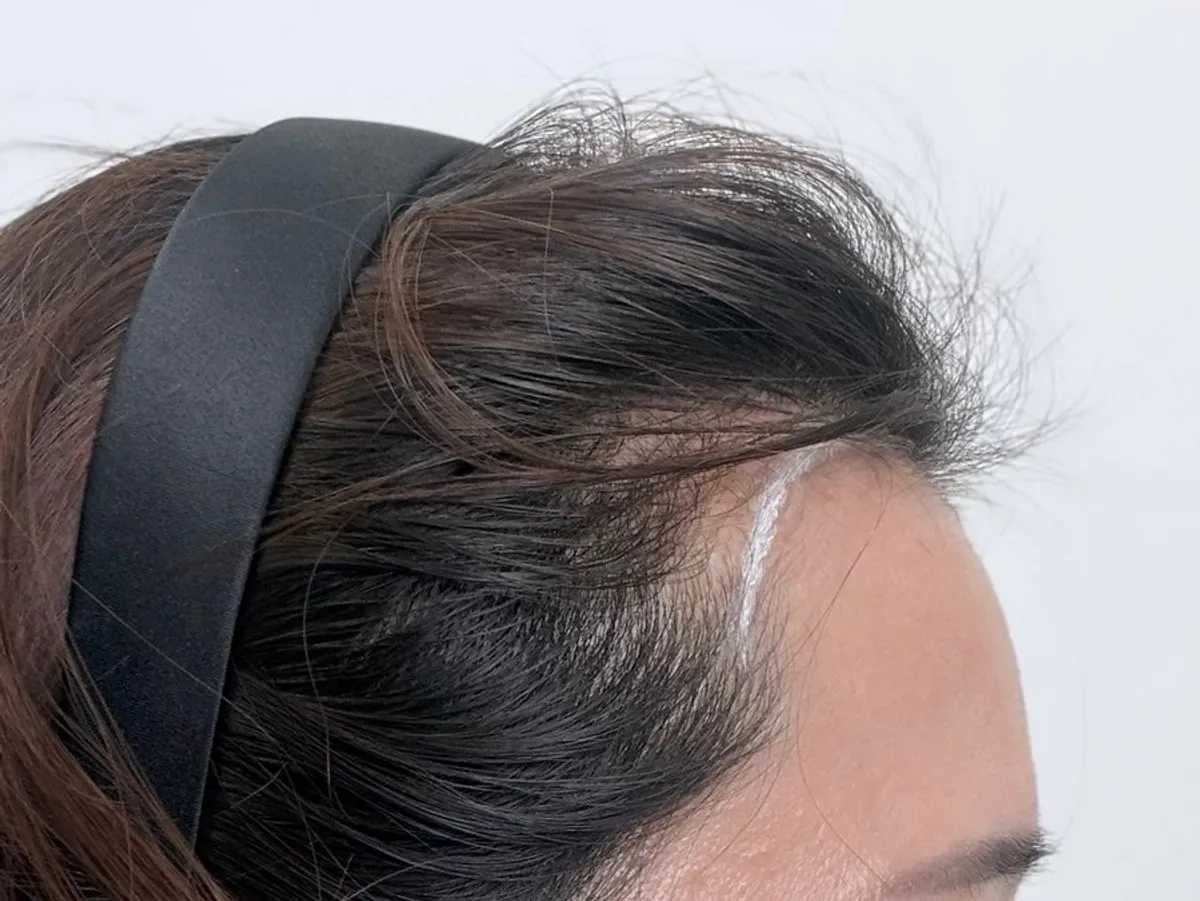 M-shaped hairline SMP procedure done without anesthesia