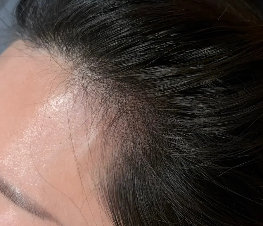 Before-and-after of the hairline right after session 1