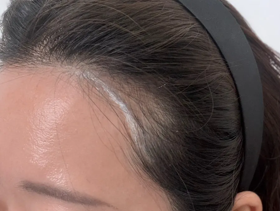 Natural hairline range after session 1