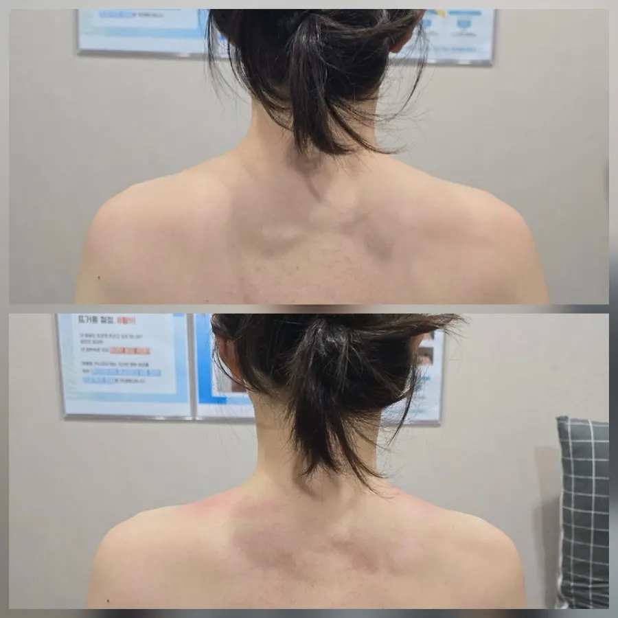 Comparison shot of shoulder and neck line after the treatment