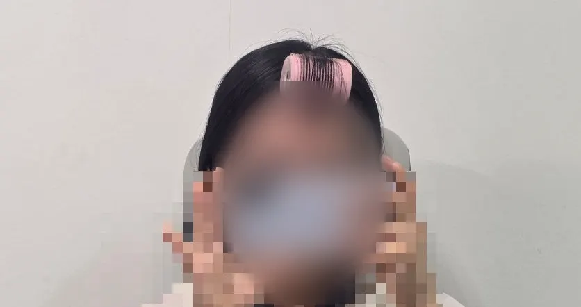 시술 전 짙은 눈썹 상태