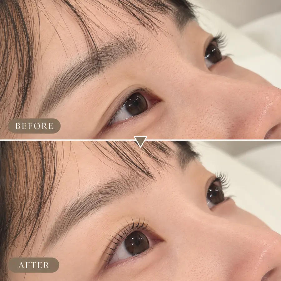 Clearer eyes after the lift