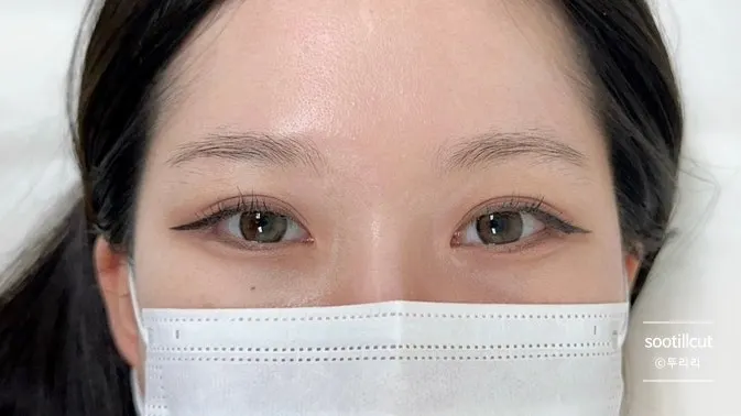 숱이 적고 비어 보이는 시술 전 눈썹