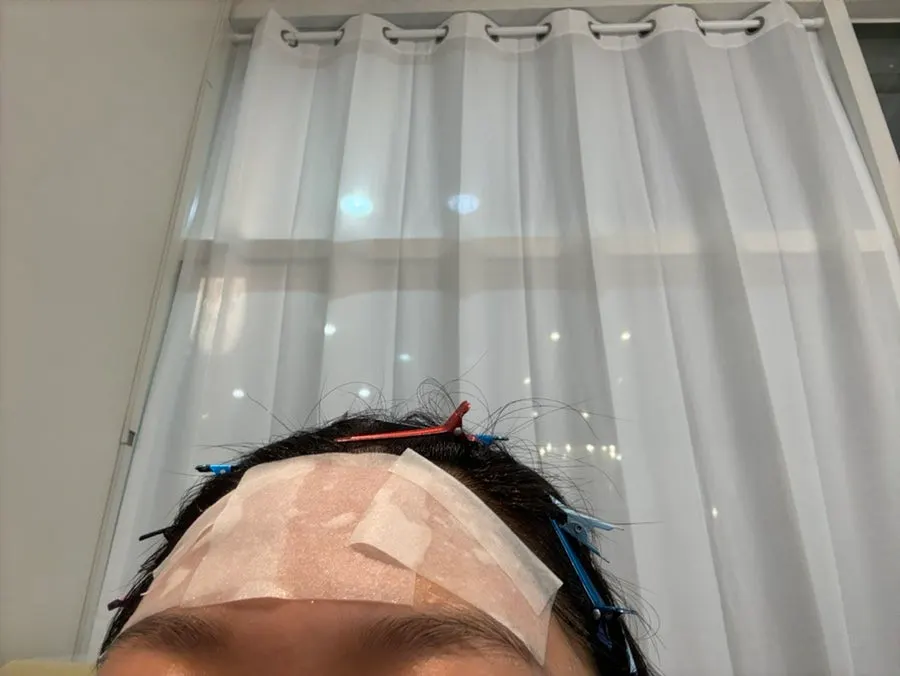 Aloe gel and soothing pack applied to the hairline