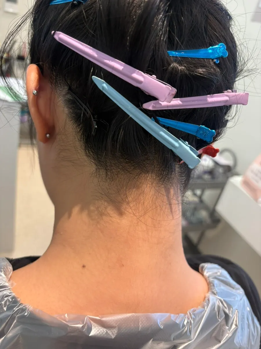 Close-up of the nape hairline before treatment