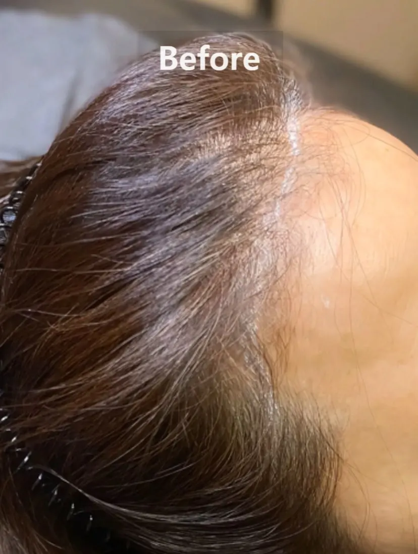 Image of looking into scalp micropigmentation because of hairline concerns