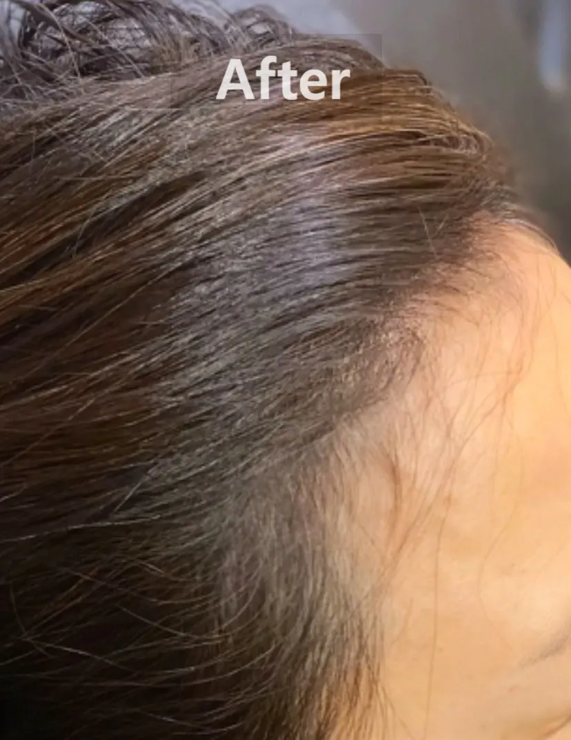 Image documenting concern over changes in the hairline