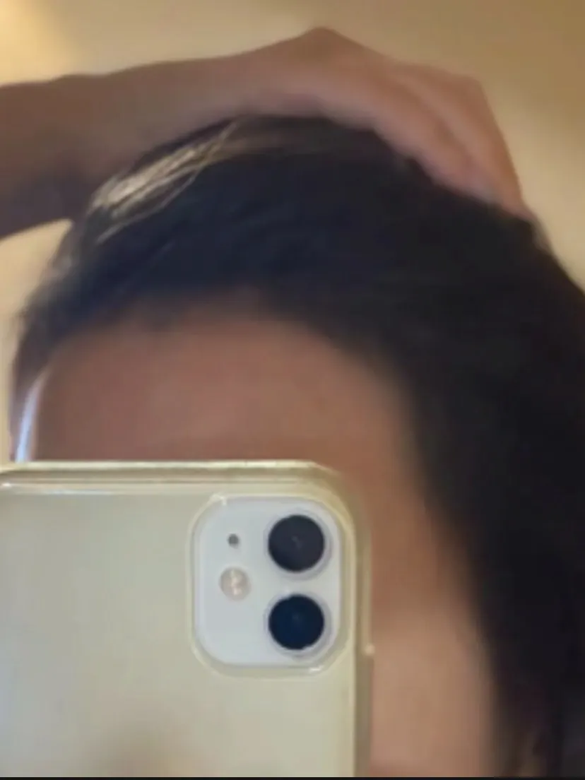 Image related to changes after the first hairline scalp micropigmentation session
