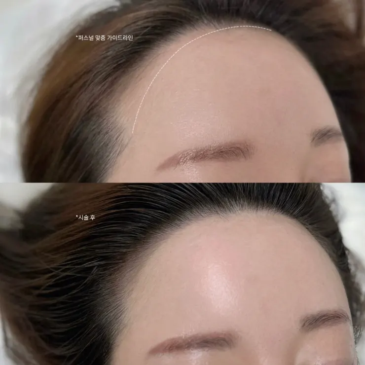 Both sides of the M-shape hairline asymmetry revealed with hair pushed back