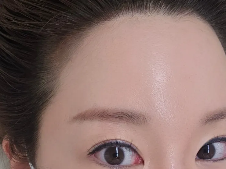 Forehead hairline right after the hair stroke treatment