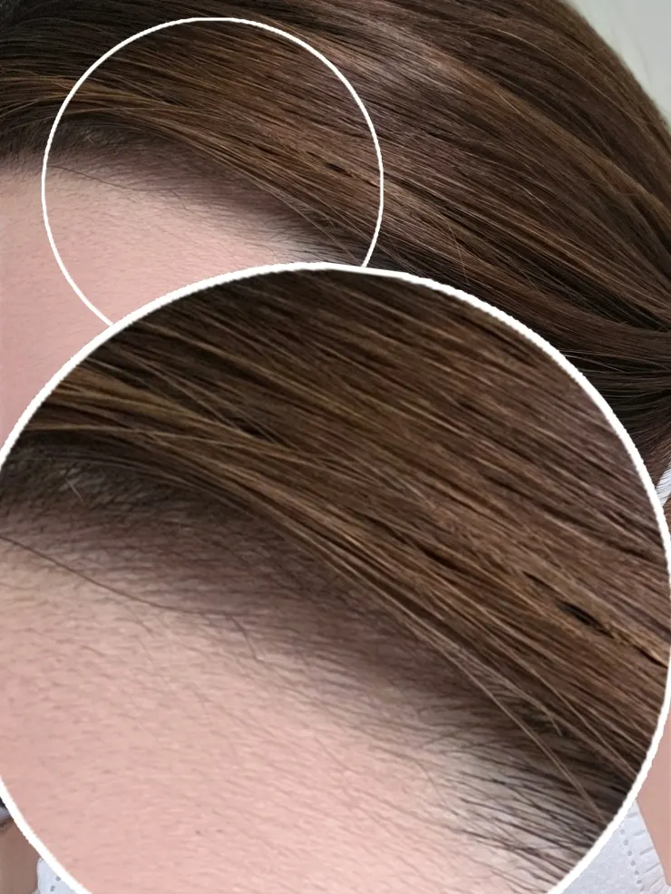 Hairline blending naturally when hair is worn down