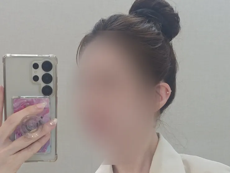 Hairline semi-permanent condition during recovery period