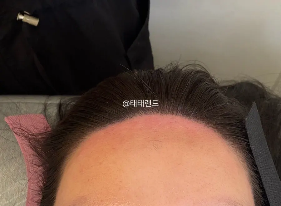 헤어라인 왁싱 전후 비교 사진