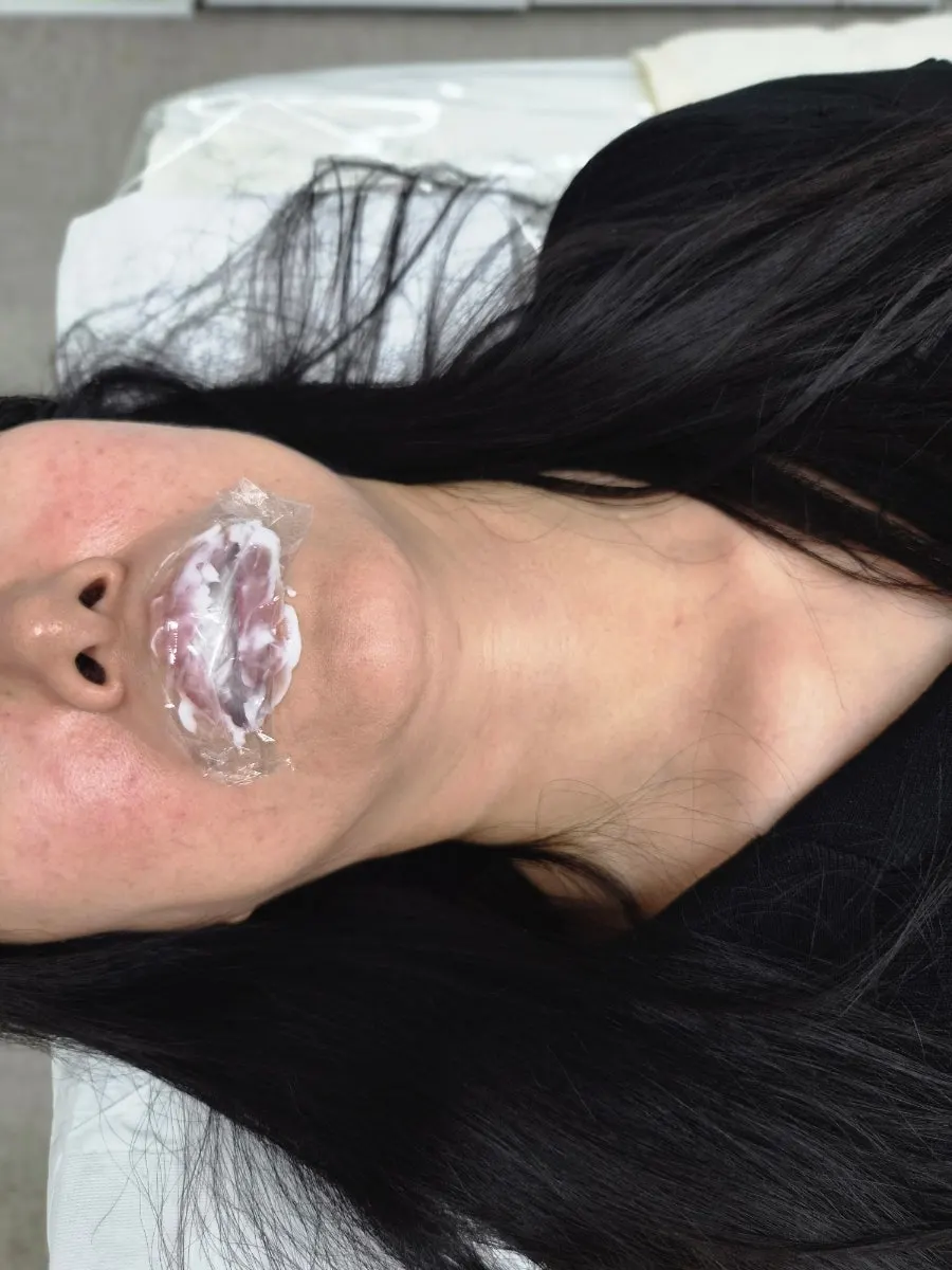 시술 전 입술 비대칭과 칙칙한 입술색