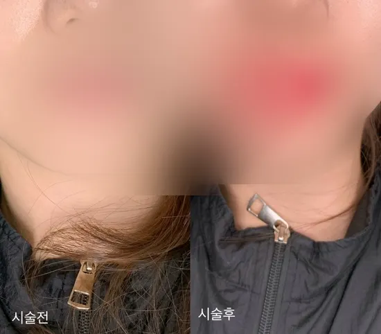 입술문신 전 혈색 없는 입술