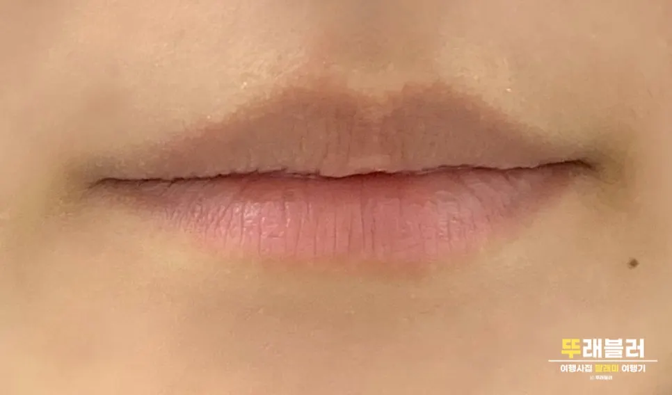 Lips before and after correcting an asymmetrical lip line