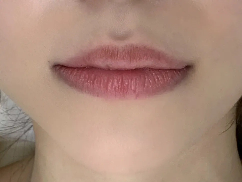 Bare lips before the procedure, showing a dark lip line