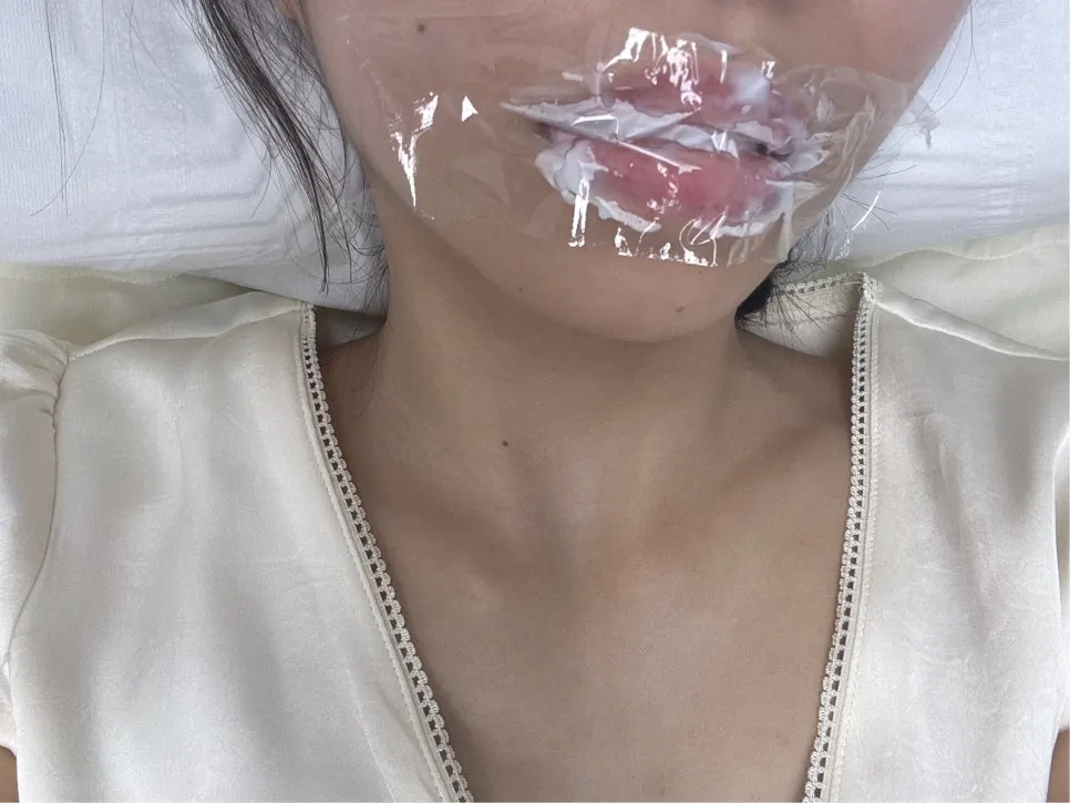 Lips with pain-relief cream applied