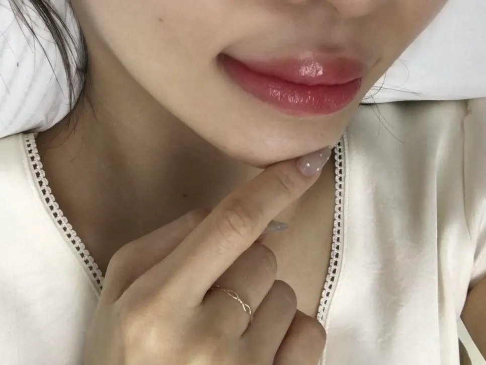 Front view of swollen lips right after the procedure