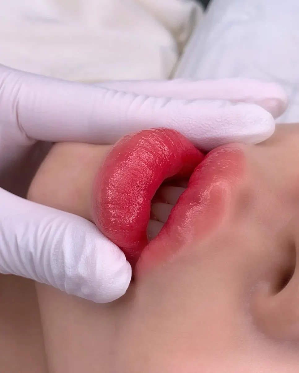 Gradient lips photographed on the day of the procedure