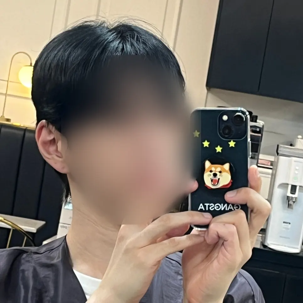 Side profile before treatment showing flared-up side hair