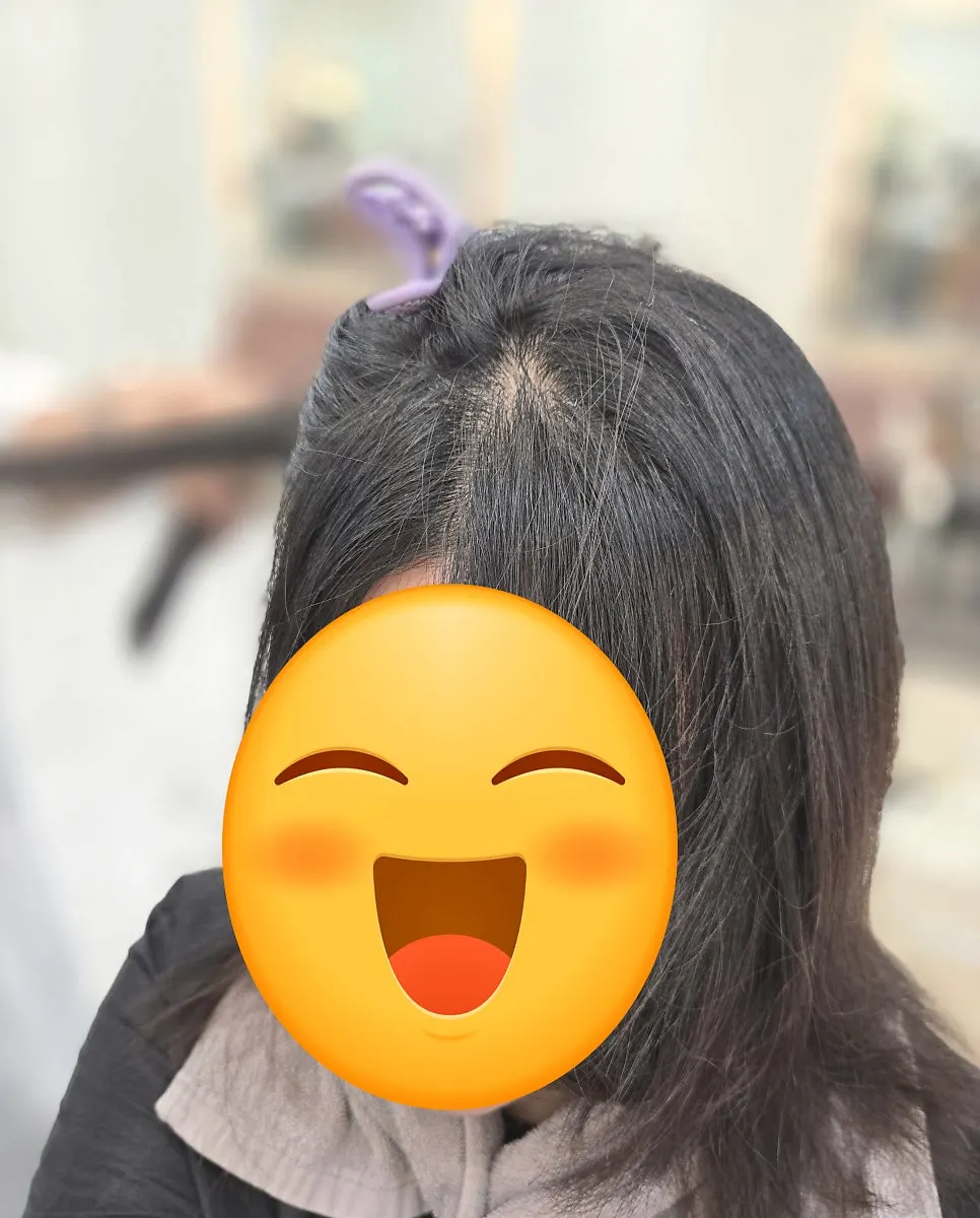 볼륨매직 시술 진행 모습