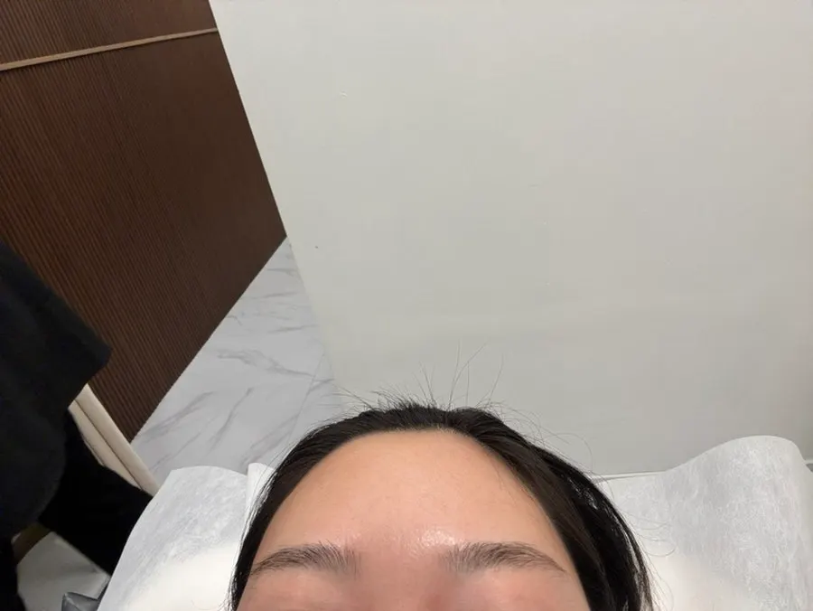 진정팩 후 붉은기가 가라앉은 눈썹