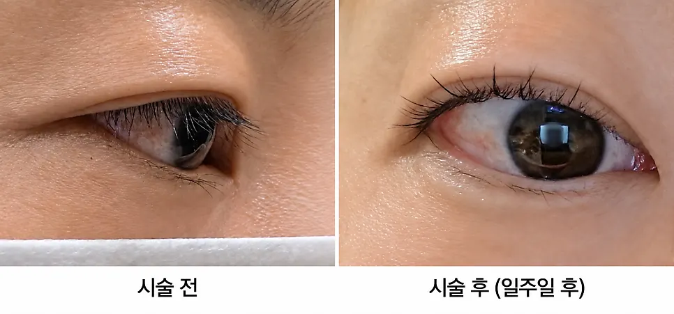 속눈썹 펌 시술 전후 비교와 일주일 후 유지 상태