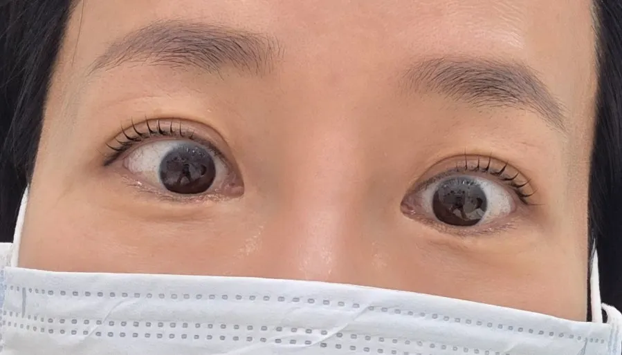 시술 후 정면에서 본 C컬 속눈썹