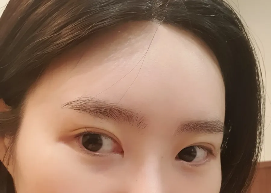 Before and after comparison of eyes stacked vertically showing lash extensions