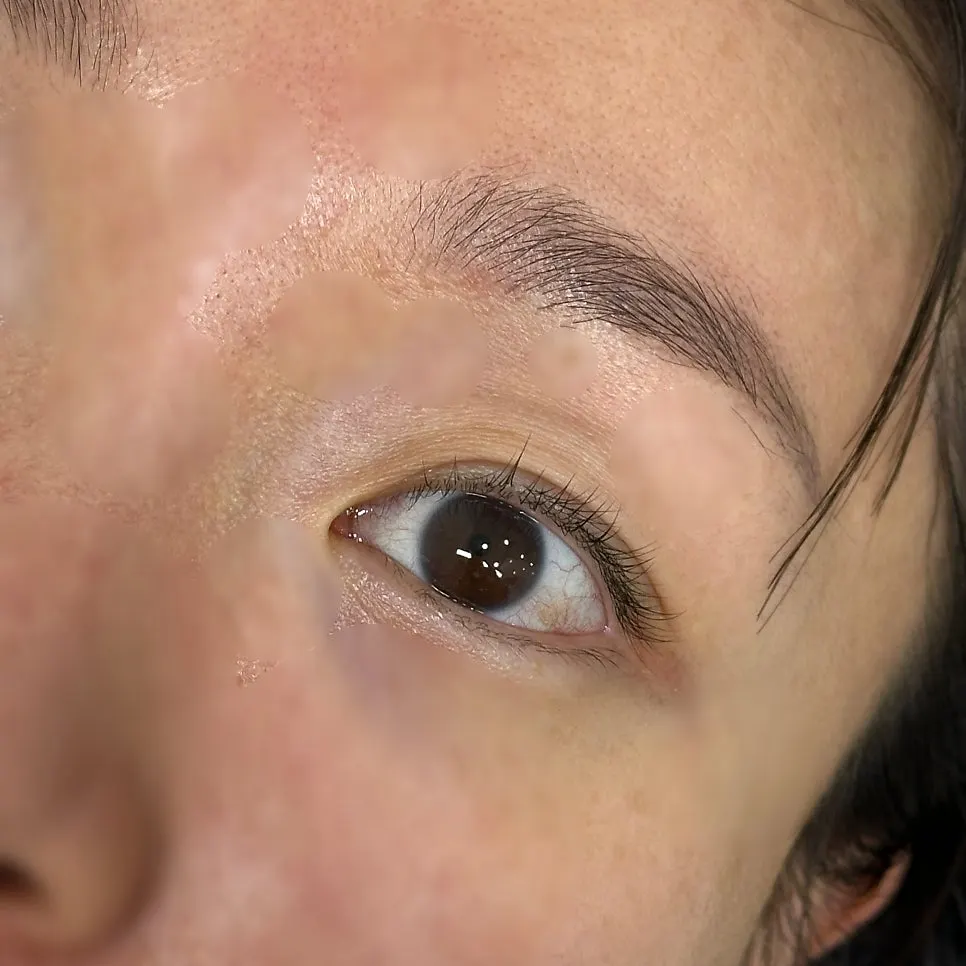 Eye area during the final stage of the treatment