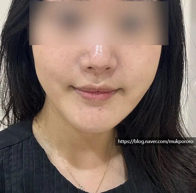 윤곽관리 후 얼굴 라인 변화