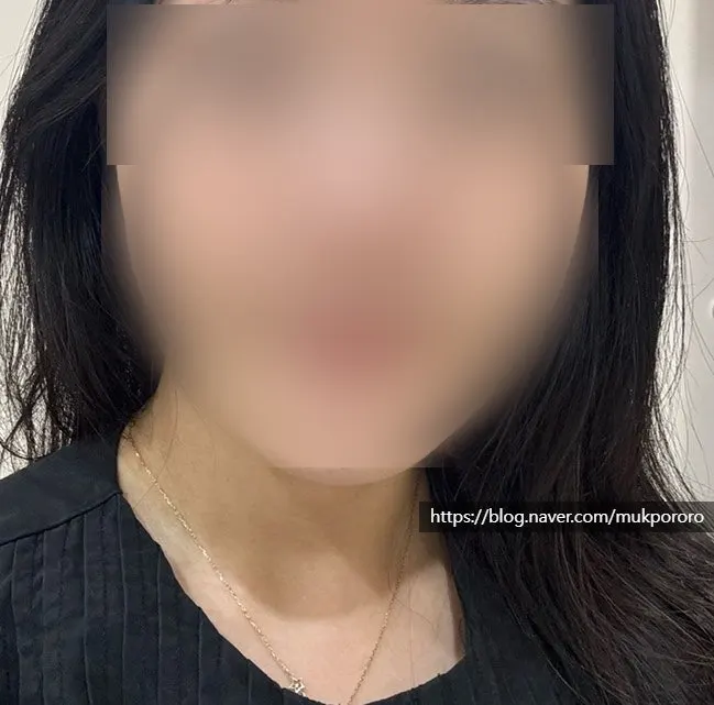 Change in facial lines after facial contouring care