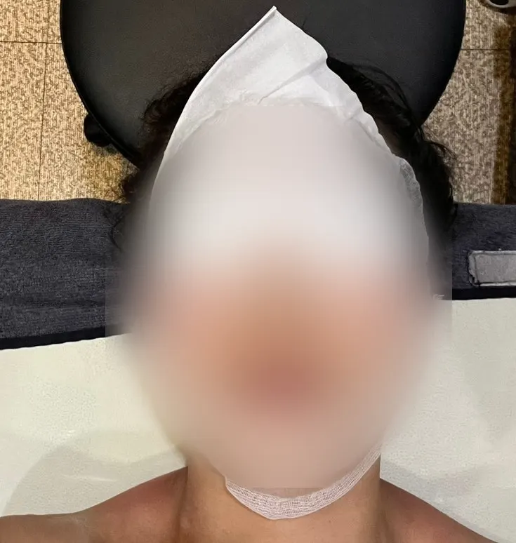 Treatment continuing from the scalp to the face line